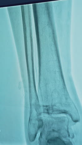 patient's bones displayed on hospital monitor. magnetic resonance. disease diagnostics. special medical equipment. computer shows x-ray of inner organs. vertical video
