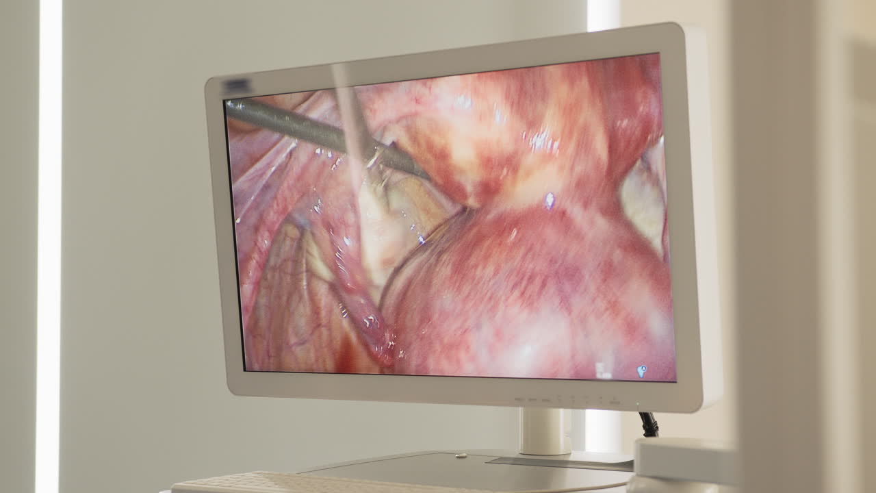 cirugía laparoscópica