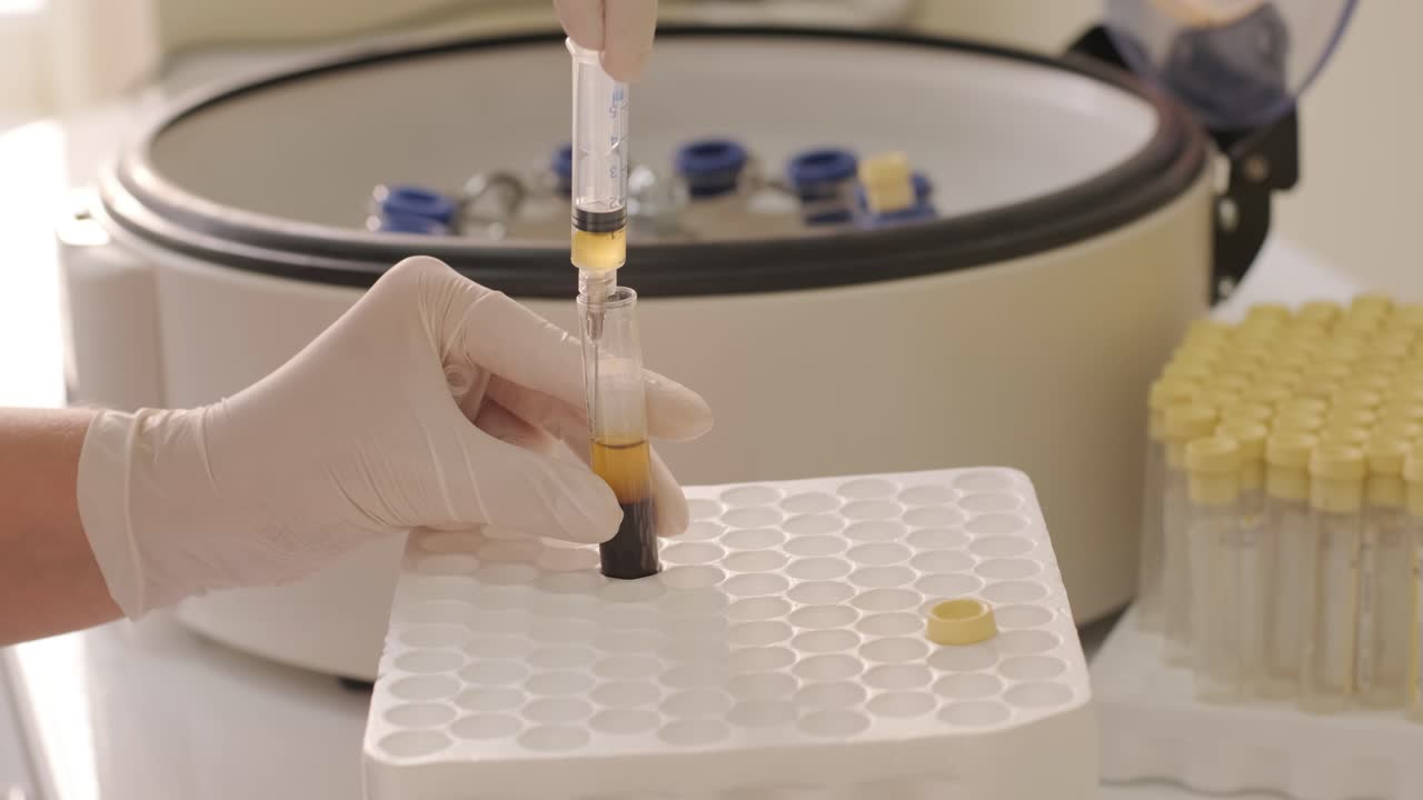 preparación de plasma rico en plaquetas. tubo con sangre en las manos.