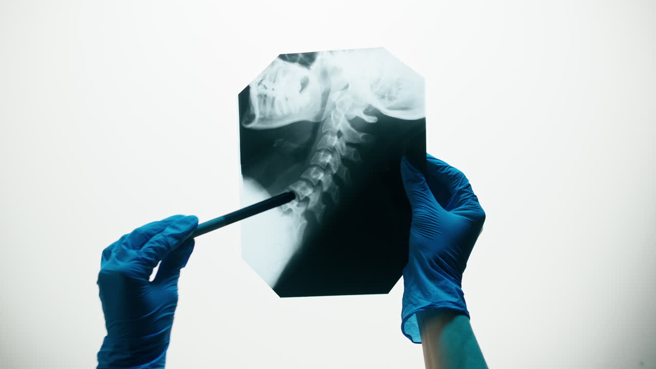 Dottore con guanti blu che esamina una radiografia della colonna cervicale con una penna