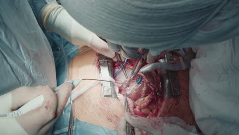 surgeon attaches graft vessels to artery. experienced doctor with assistant performs coronary artery bypass surgery in operating room closeup