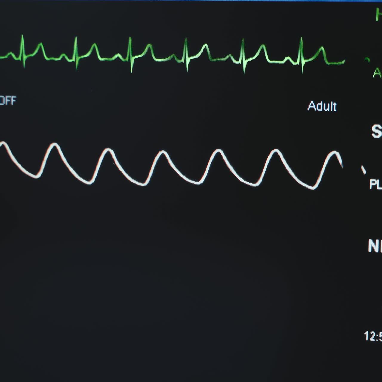 Life signs and parameters of a patient under operation. Black monitor close up in the modern surgical room