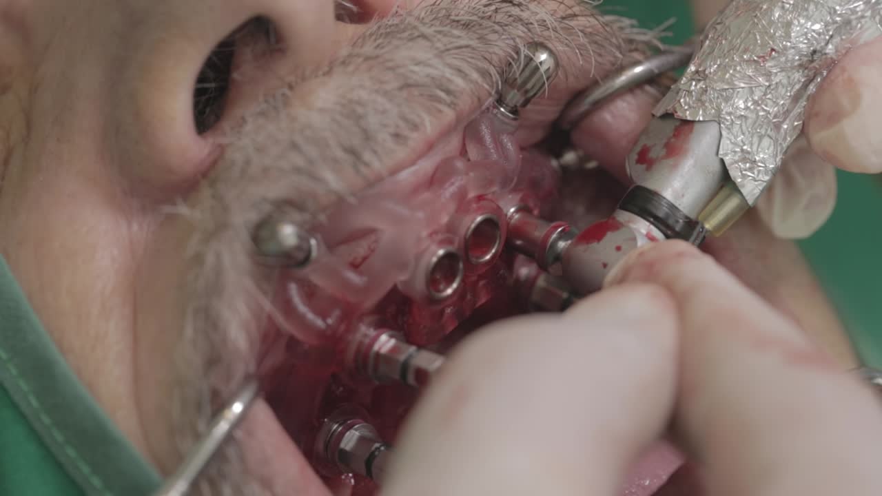 Dental Implant Surgery: Procedure and Process