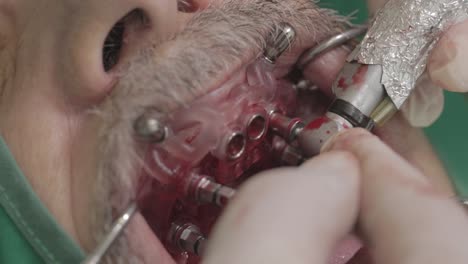 dental implant surgery: procedure and process