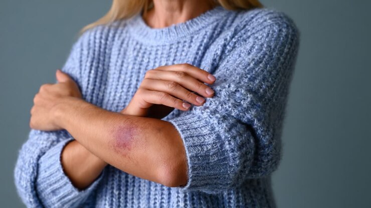 A Close-up Look at an Arm with Bruise and Crossed Arms in Cozy Sweater, Highlighting Signs of Injury and Resilience in a Soft, Calm Setting