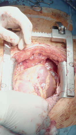 el médico retira el equipo que opera el corazón. un cirujano cardiotorácico hábil con asistente termina una complicada cirugía de bypass de la arteria coronaria de cerca