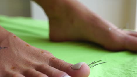 therapist performing moxibustion and acupuncture procedure at health center. moxibustion is a thermal effect on biologically active points located across the entire surface of the human body