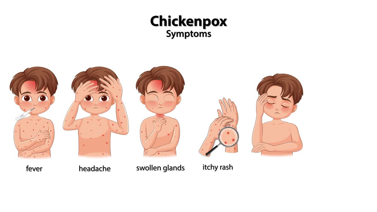 Cartoon animation sequentially illustrates chickenpox symptoms in boy, highlighting fever, rash, fatigue, and more