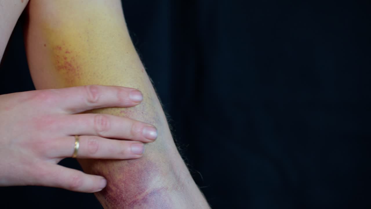 Close up of extensive bruising on man's arm after ruptured biceps, changing colors one day after being injured.