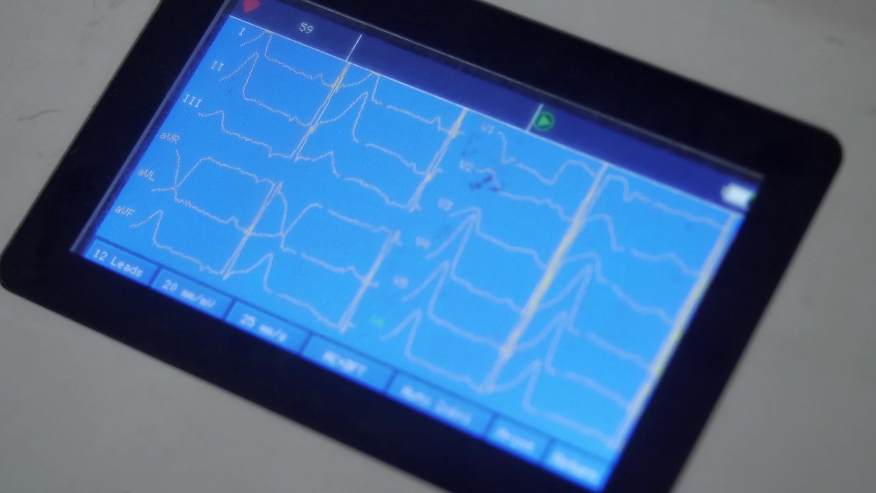 Display della macchina ECG che indica la frequenza cardiaca e la condizione del cuore di un paziente adulto. Vista ravvicinata.