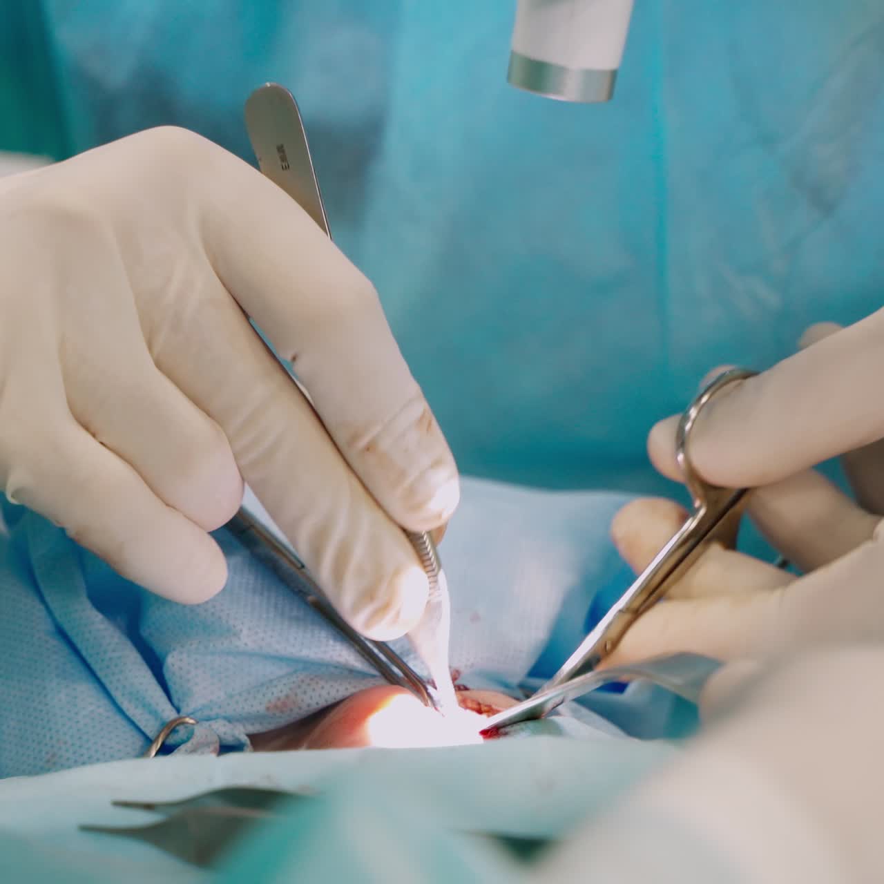 Surgical process in the intensive care unit. Doctor's hands in sterile gloves working with medical instruments in a patient's body. Close-up.