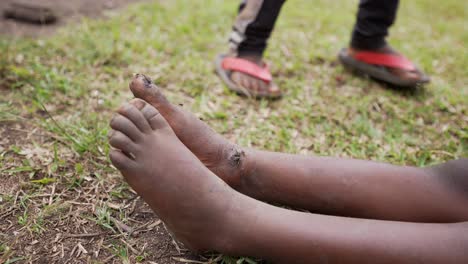 dramáticos pies de niños africanos pobres con heridas y moscas alrededor