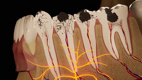 molar teeth damaged by caries. medically accurate tooth 3d animation