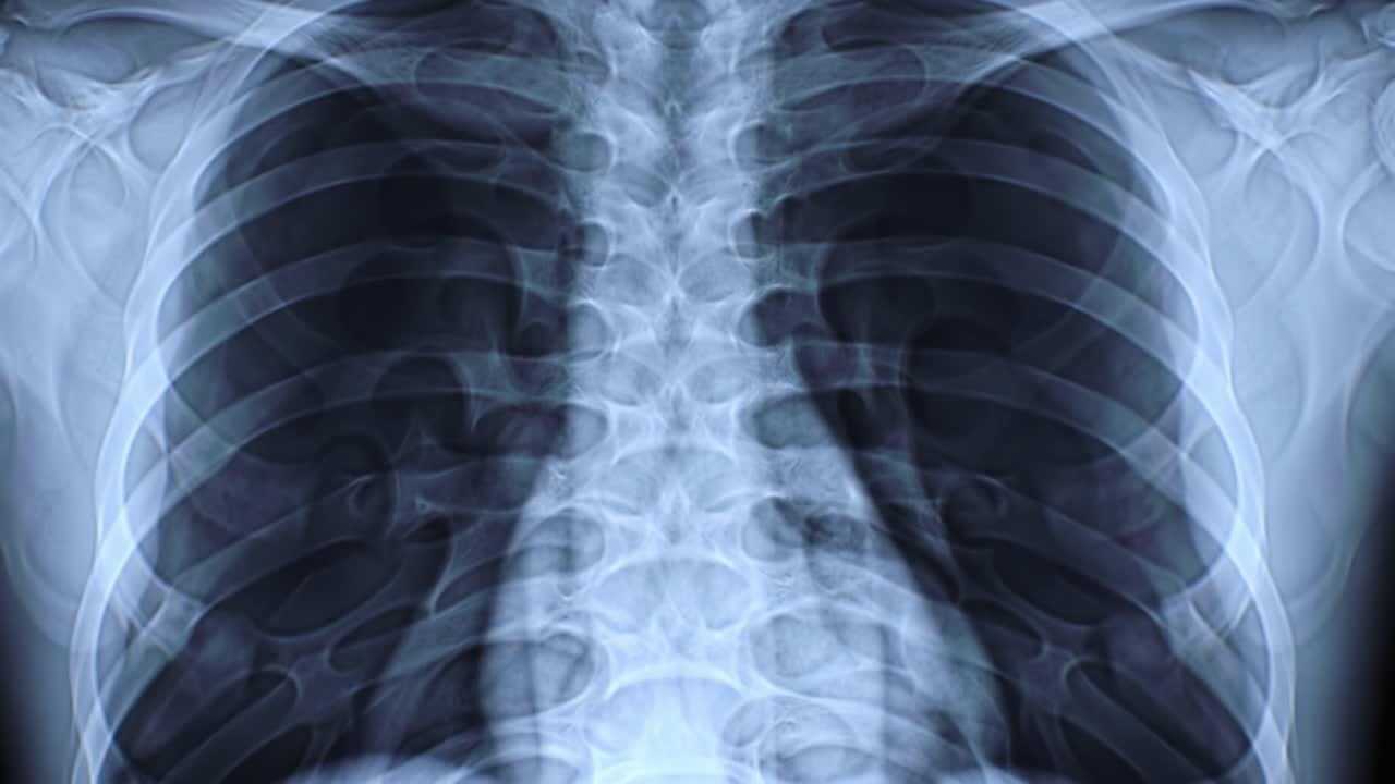 This presentation analyzes a chest X-ray highlighting the lung structures and ribcage. Viewers learn about common observations and interpretations for better understanding.