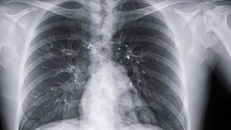 a chest x-ray highlighting the lungs and surrounding structures, revealing key details for clinical assessment and diagnosis.