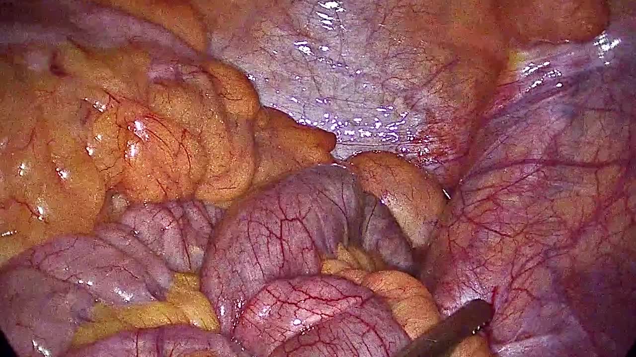 хирургия аппендицита