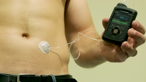 hombre diabético con una bomba de insulina conectada en su abdomen y sosteniendo la bomba de insulina en sus manos. concepto de diabetes.