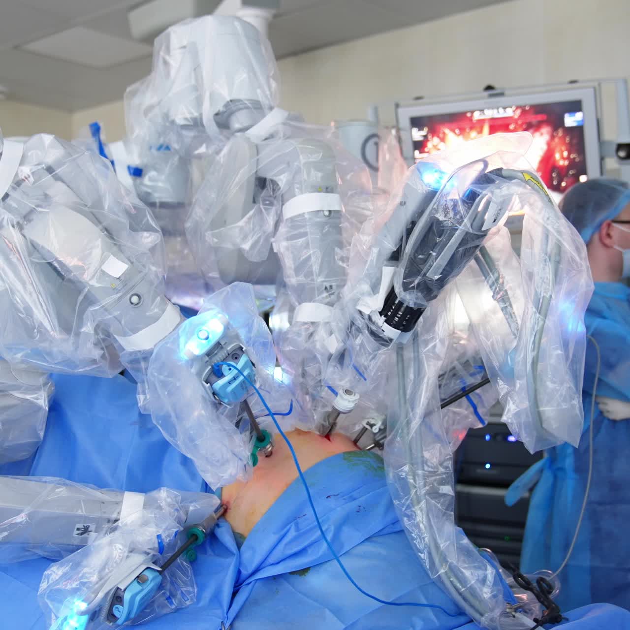Minimum invasive surgery conducted by the Da Vinci robot. Robotic arms are input into small cuts at patient's body. Surgeon controlling the process