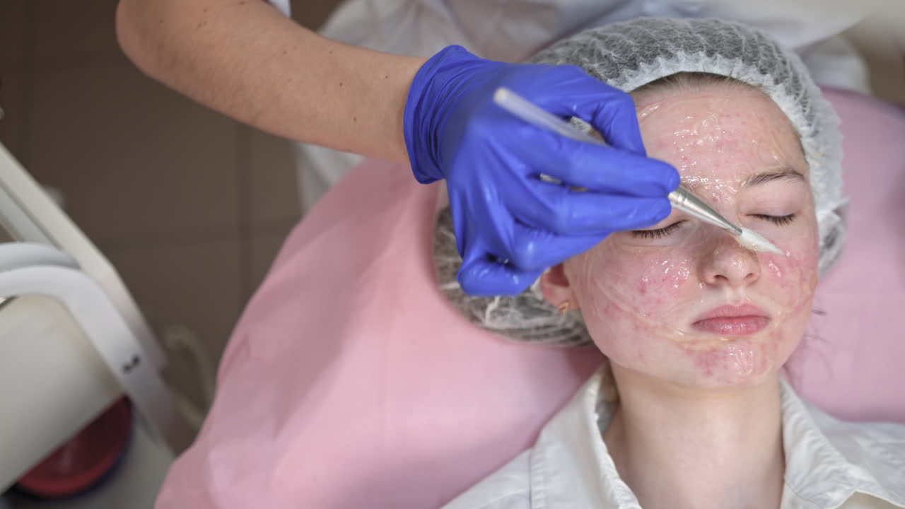 Acne Treatment Facial Procedure