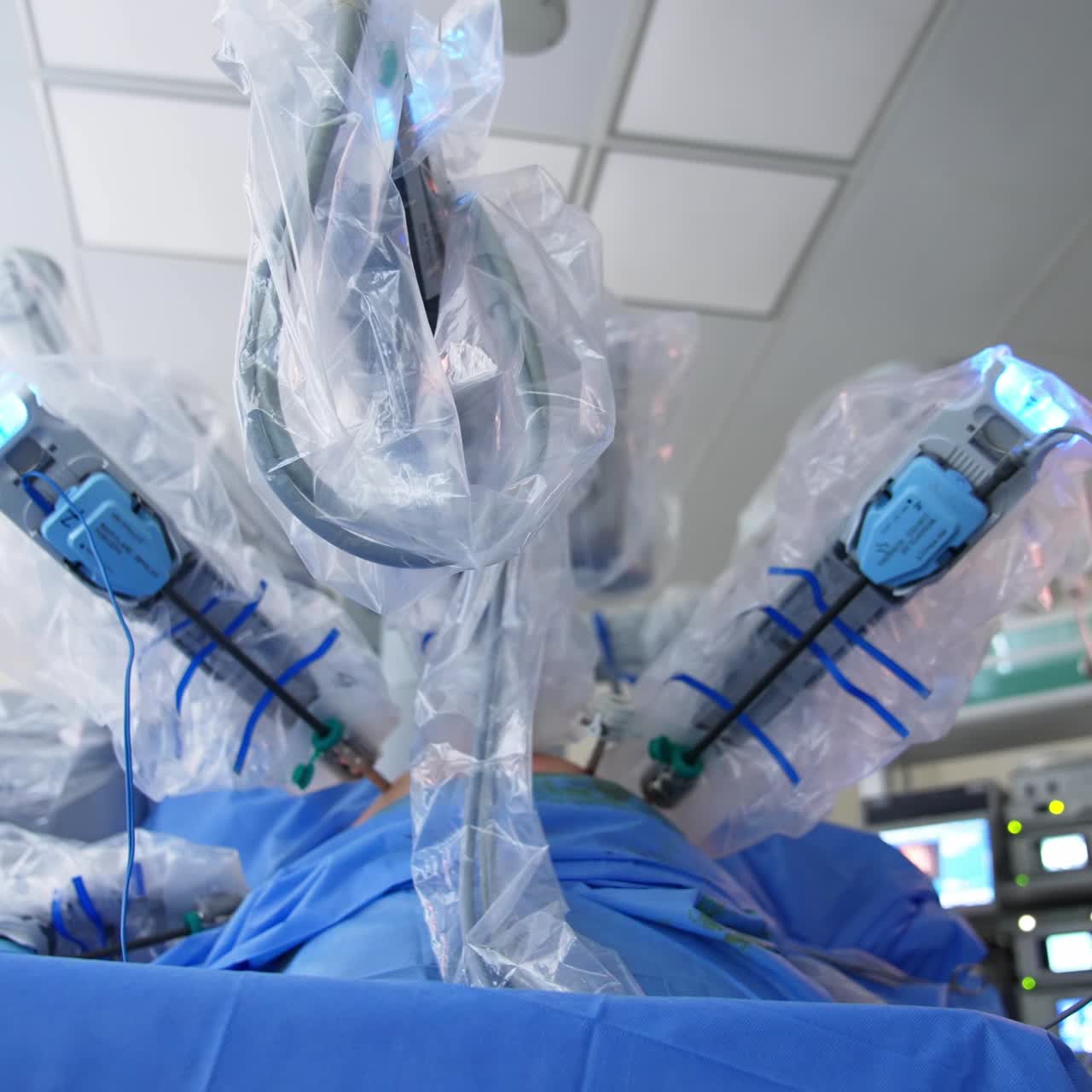 Laparoscopic operation conducted by Da Vinci surgeon. Futuristic equipment working in modern hospital room