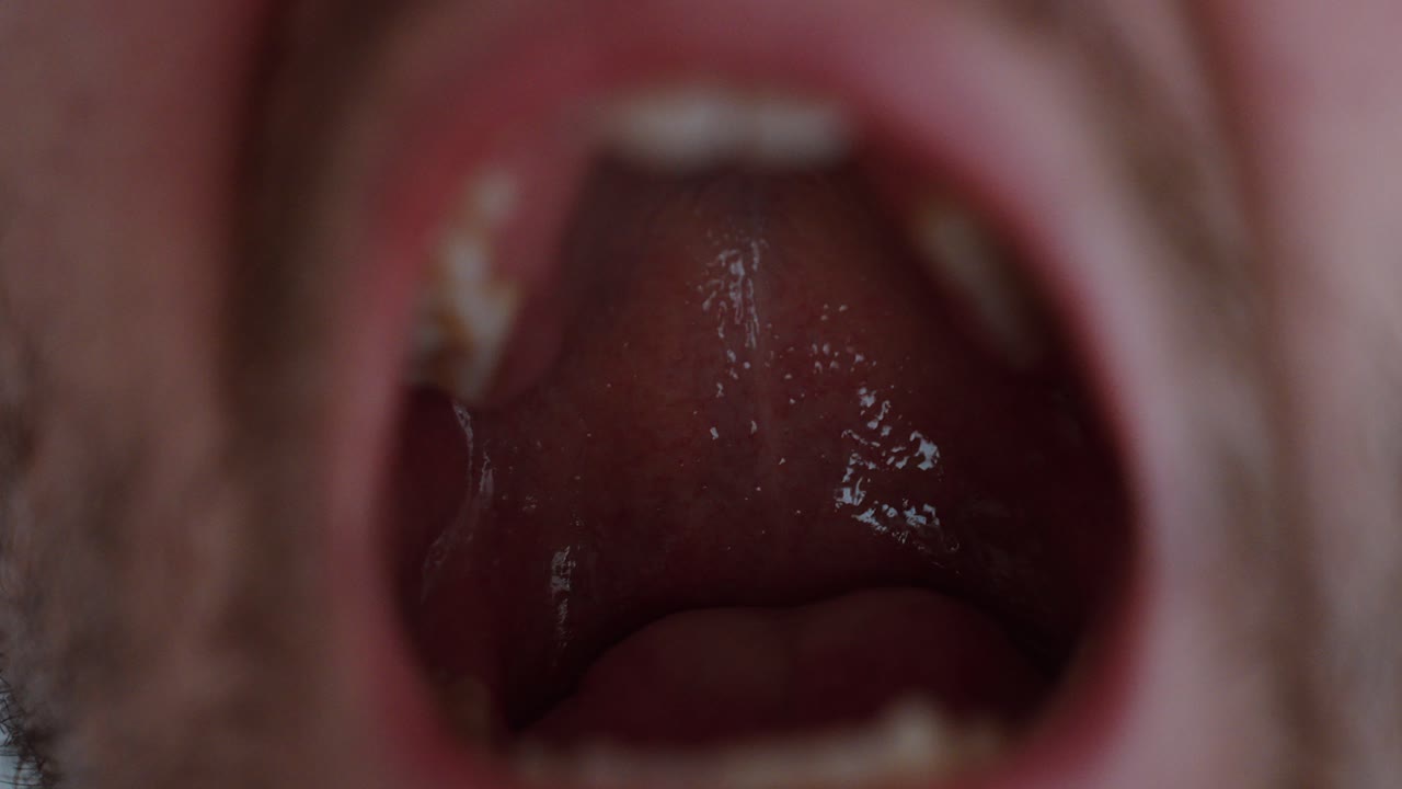 Primo piano estremo di un uomo con la bocca aperta, che mostra la gola e la cavità orale. Concetto di esame medico, controllo dentale, mal di gola, infezione e diagnostica sanitaria.