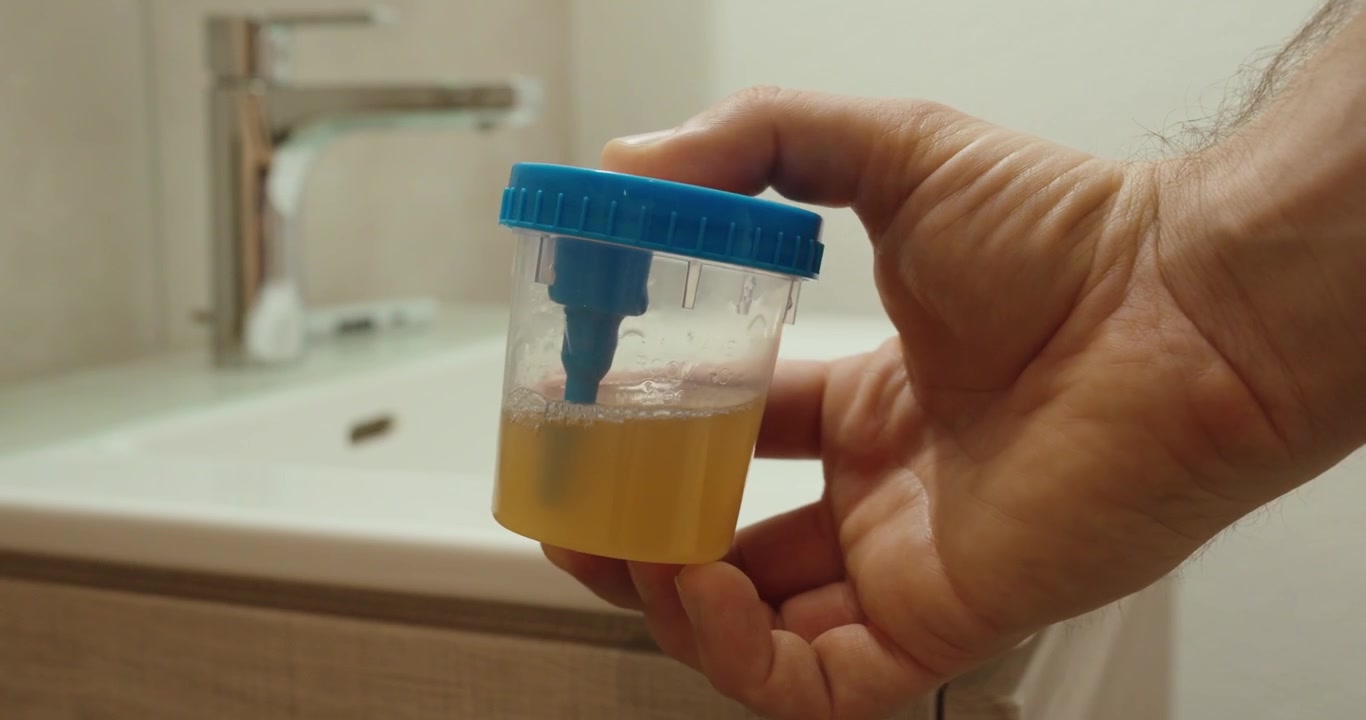 Close-up of a person holding a urine sample container with bare hands, highlighting hygiene risks and improper handling in medical testing.