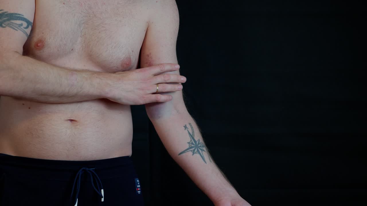 Man fingers, examines bruising on left arm just above elbow, area of ruptured biceps and chest muscle, black background