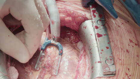 surgeon hand attaches graft vessels. chest cavity opened with retractors for careful work on small coronary artery to divert blood supply closeup