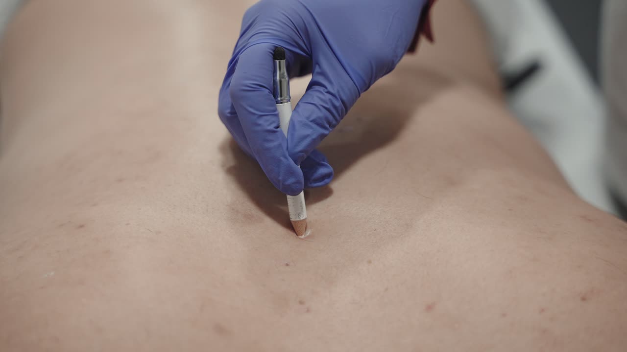 marcar la piel con lápiz blanco para la seguridad del láser antes de la depilación