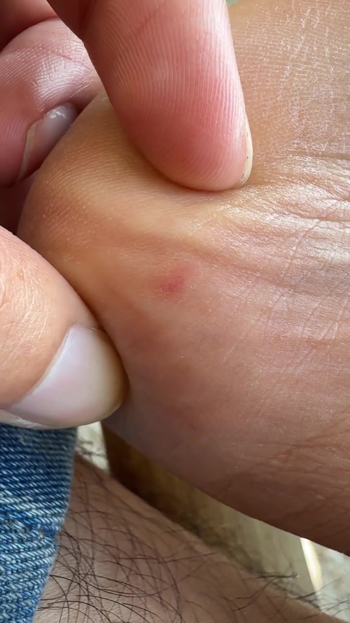 Primo piano di una macchia rossa sul tallone di una persona in fase di esame