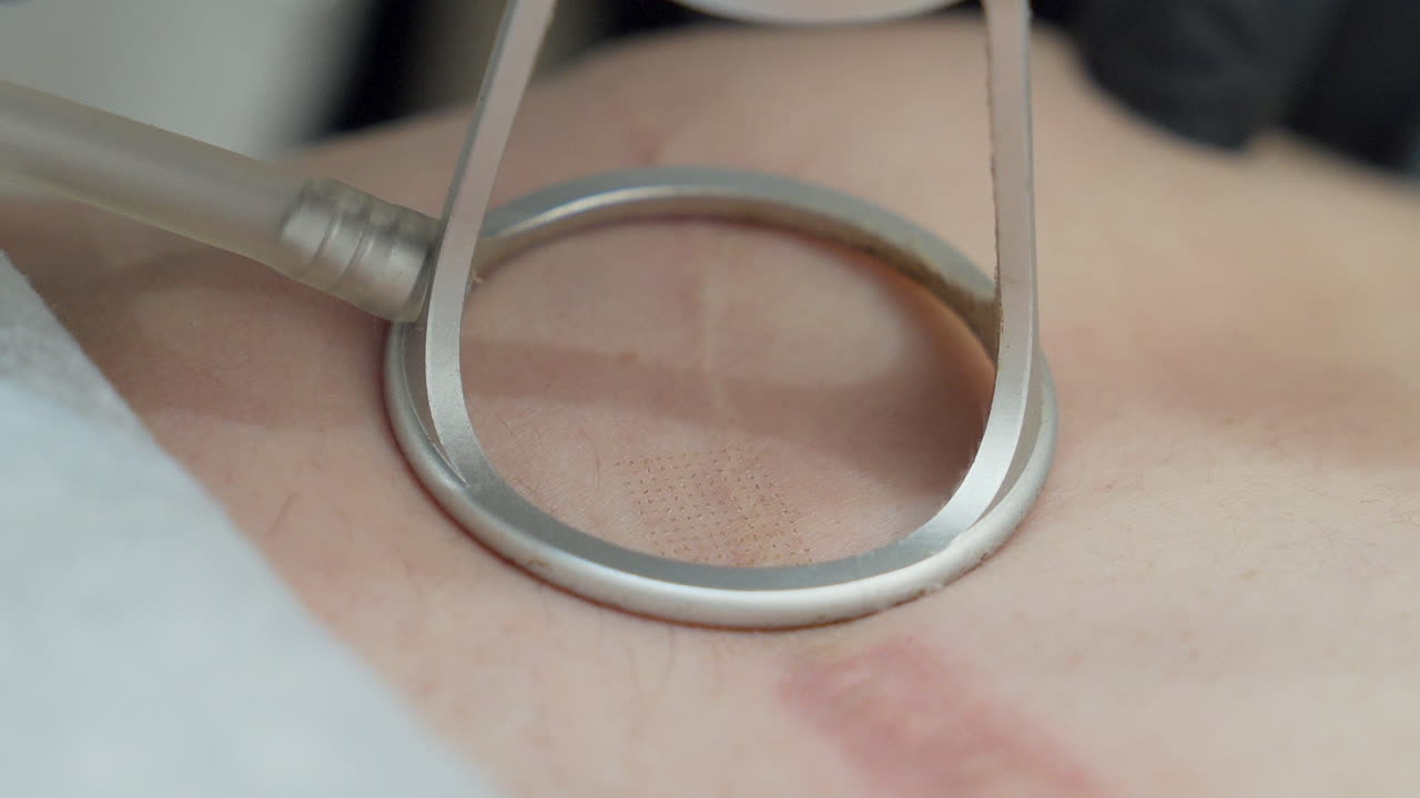 Close-up of CO2 laser treatment on abdominal scar. A non-invasive procedure that improves skin texture and reduces scar visibility through collagen stimulation.