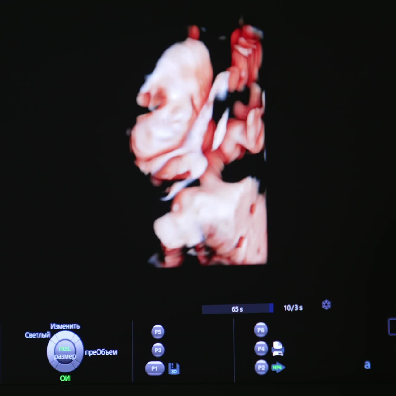 Watching the unborn baby move in mom's abdomen. Child image on the screen of ultrasound machine