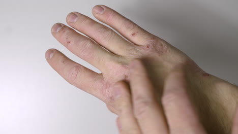 caucasian hands with psoriasis or eczema sickness - hand skin disease concept - close up shot