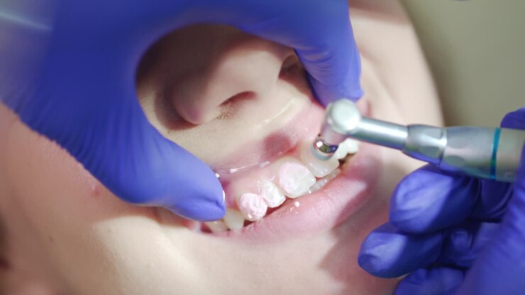 Professional removing teeth plaque in dental office. Close up teeth polishing