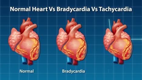 animation comparing normal, slow, and fast heartbeats.