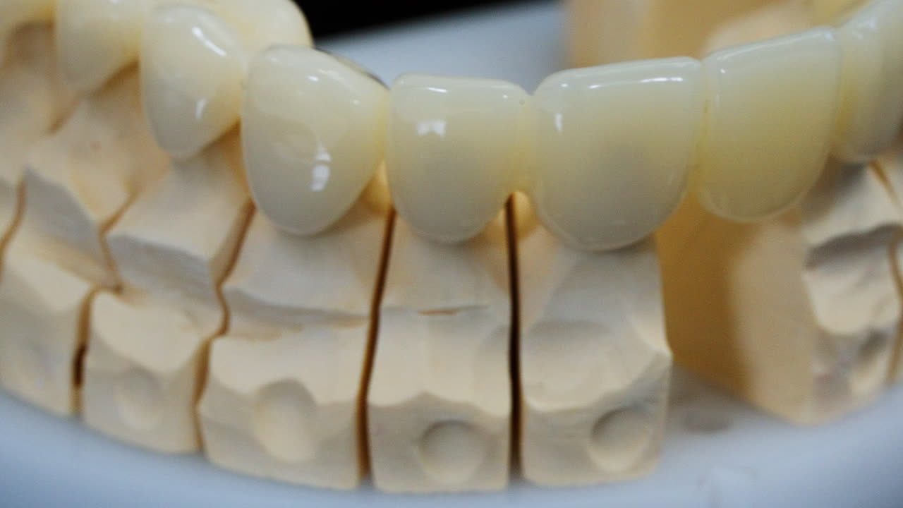 Primo piano di protesi a ponte in ceramica montata su un modello in gesso utilizzato per la pianificazione ortodontica e il restauro protesico. Vista dettagliata di denti artificiali impiegati nell'odontoiatria moderna.