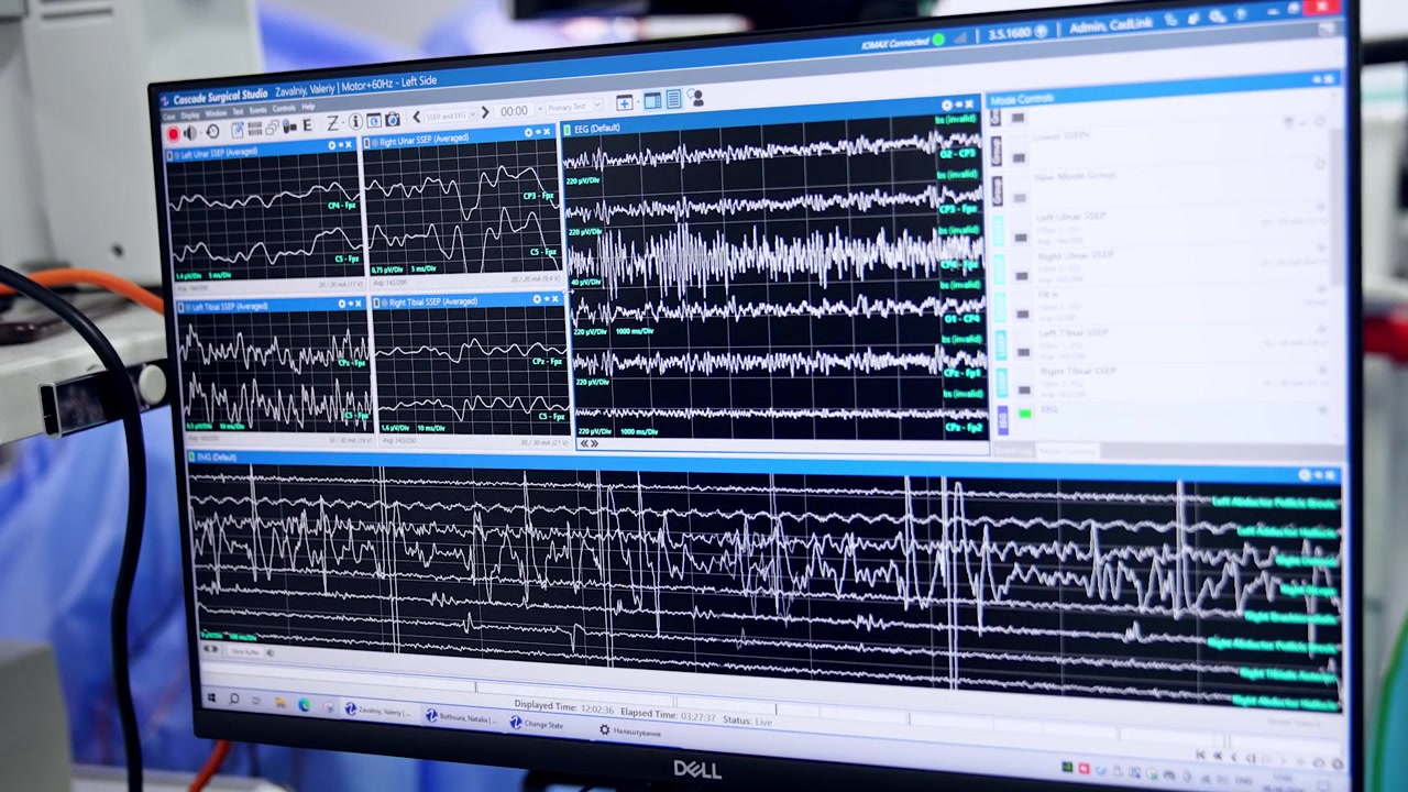 Linee curve che cambiano sul monitor del computer. Apparecchiatura che mostra le onde cerebrali durante un intervento al cervello. Primo piano