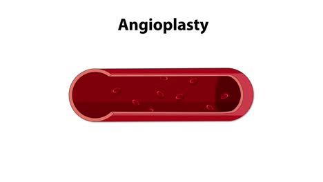 visual sequence of a balloon angioplasty procedure