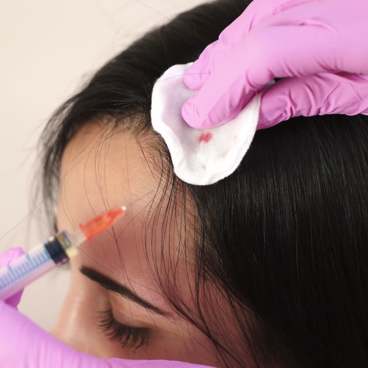 Needle mesotherapy. Cosmetologist makes injections into the scalp. Thrust to strengthen hair and their growth