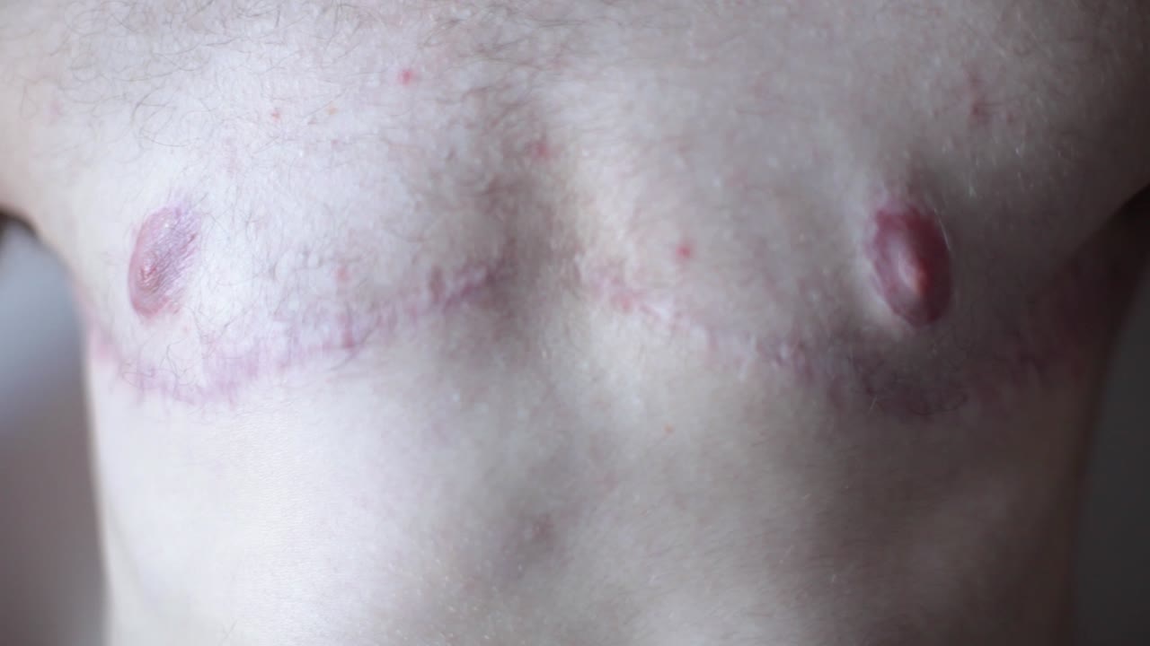 Transgender Man showing Surgery Scars on Chest