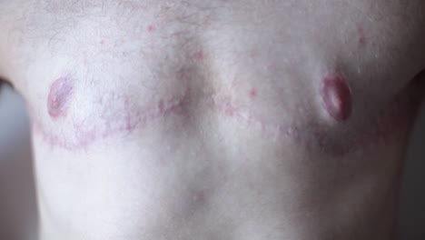 transgender man showing surgery scars on chest