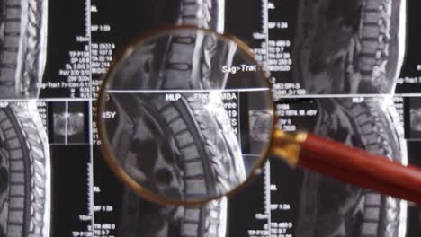 resonancia magnética de fondo de la columna lumbar, tomografía por resonancia magnética. el médico examina la resonancia magnética de la columna lumbar con discos pellizcados de la columna vertebral y los nervios.