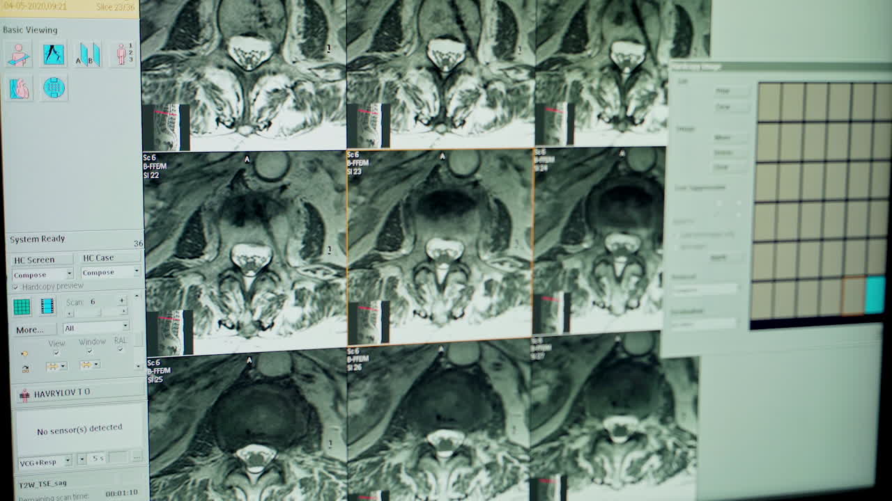 X-ray scan of the patient. Close up view of x-ray on computer