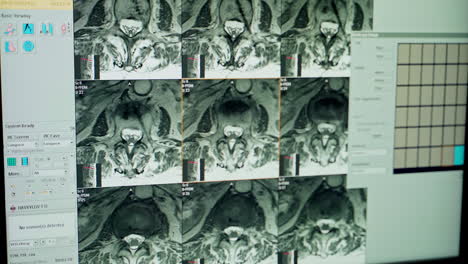 x-ray scan of the patient. close up view of x-ray on computer