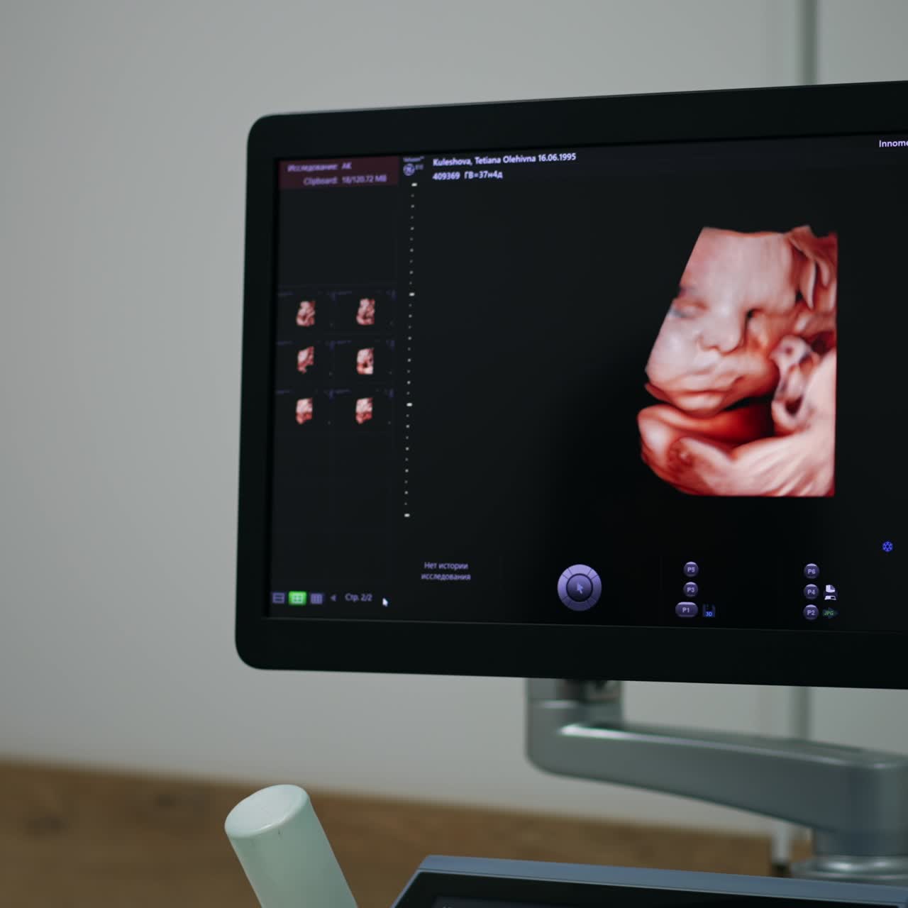 Cute unborn baby picture on the screen of modern ultrasound equipment. Female specialist sitting in front of apparatus checking the patient's condition
