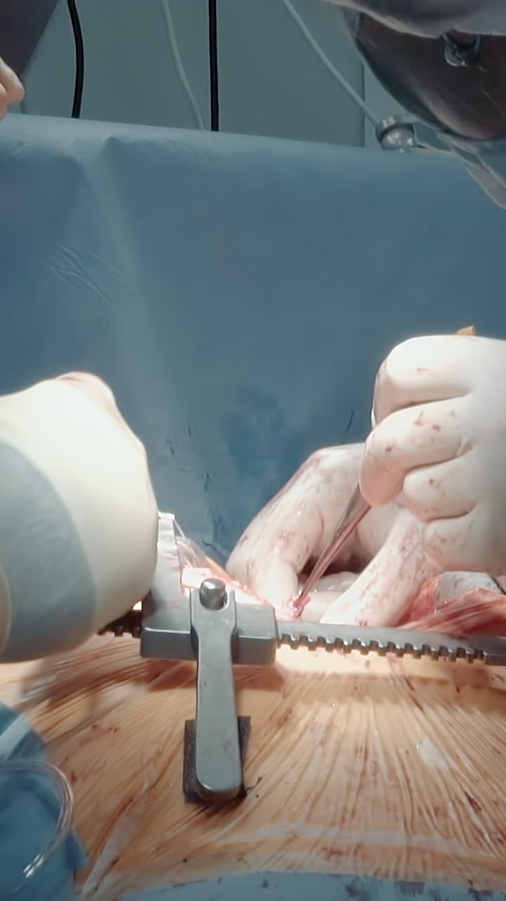 수술 중에 마이크로 포르을 사용합니다. 심장 외과 의사와 수술 팀은 가 구을 열고 가죽 절단을 바느질을 준비합니다.