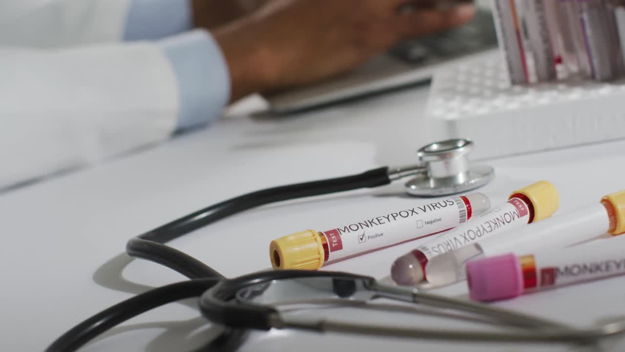 viales con el virus de la viruela del mono y un estetoscopio sobre un médico afroamericano usando una computadora portátil