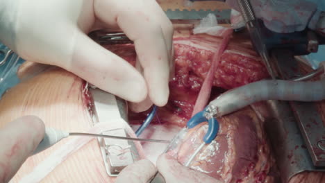 surgeon hands attach graft to artery. skilled doctors perform complicated surgery on patient beating heart creating new pathway to divert blood supply