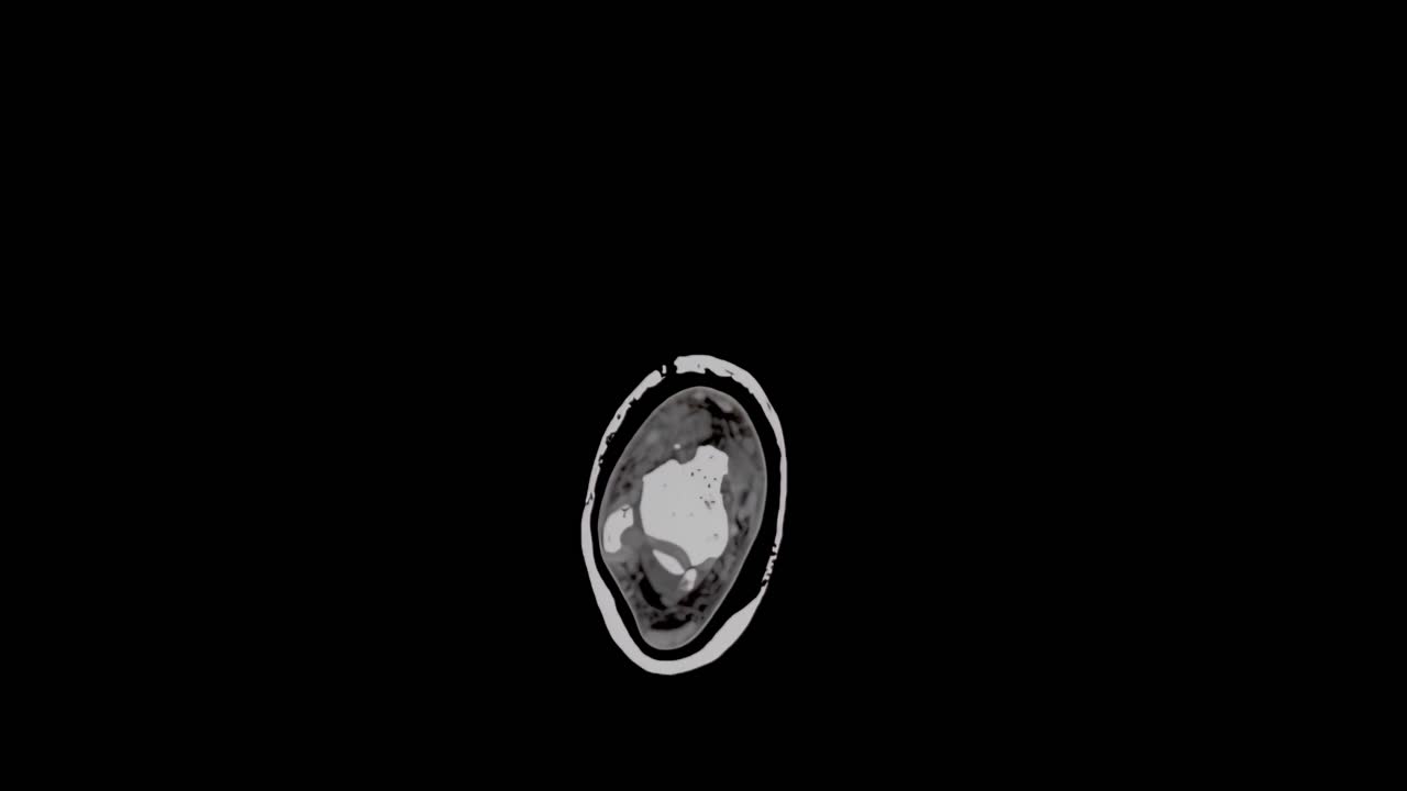 Risonanza magnetica di un piede che mostra multiple piccole fratture, scansione lenta dall'alto verso il basso che mostra l'intero piede