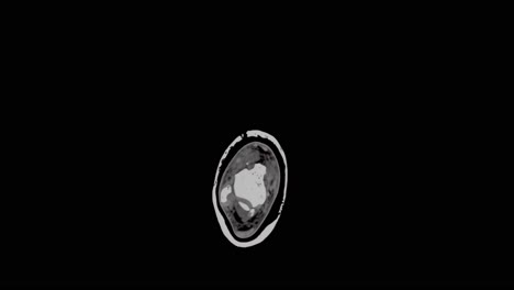 Resonancia-Magnética-De-Un-Pie-Que-Muestra-Múltiples-Fracturas-Pequeñas,-Escaneando-Lentamente-De-Arriba-A-Abajo-Y-Mostrando-Todo-El-Pie